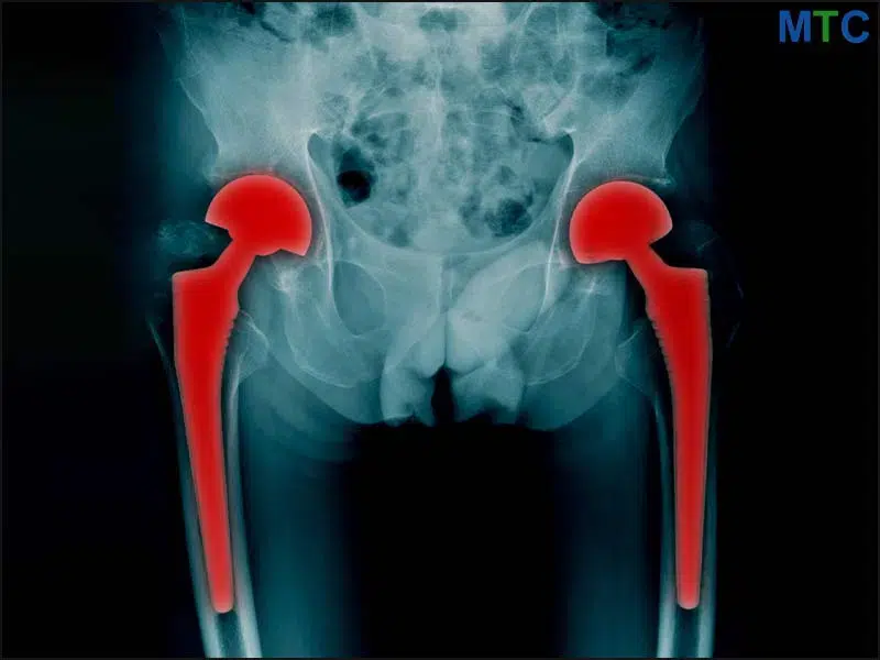 Hip Replacement Surgery in Bangalore, India