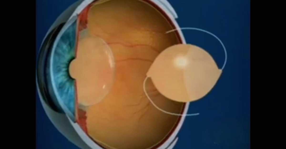 Cataract Lens Options in Cancun – Mexico