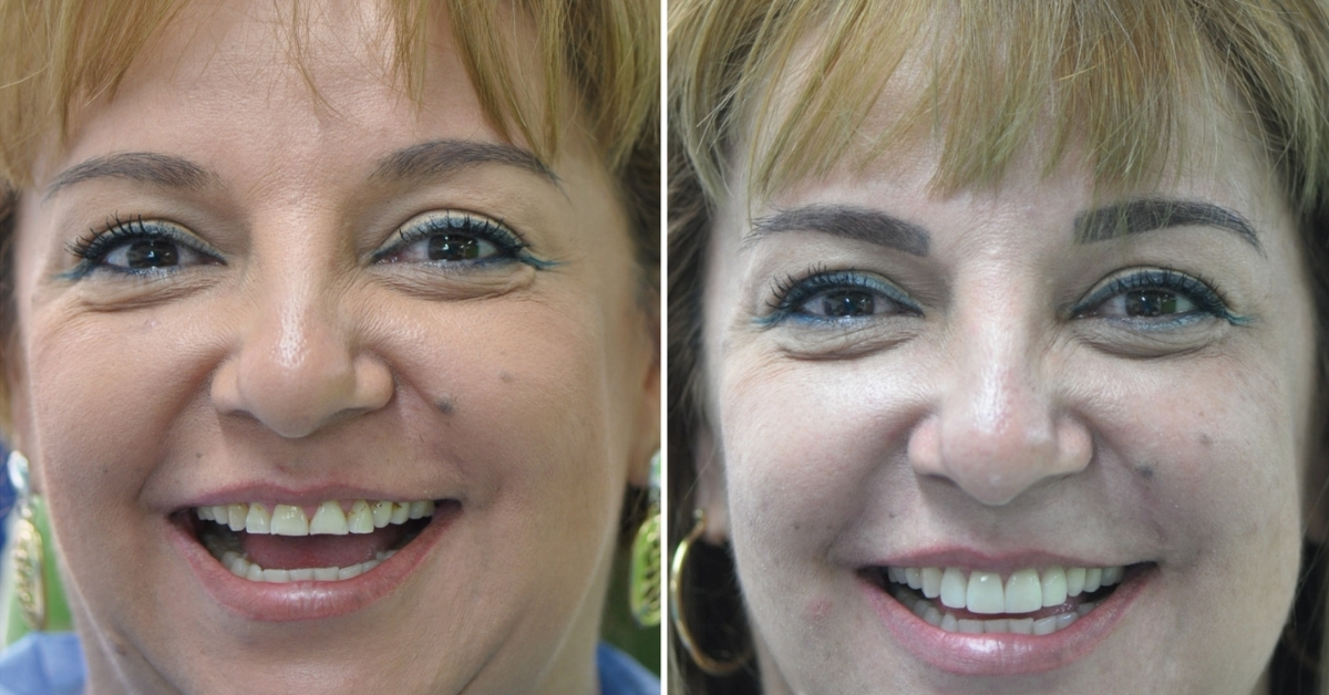 Cosmetic Dentistry in Colombia