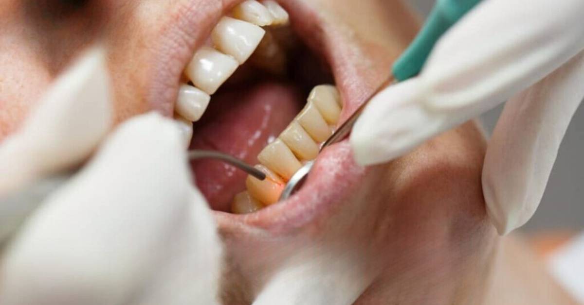 Dental Work in Bengaluru