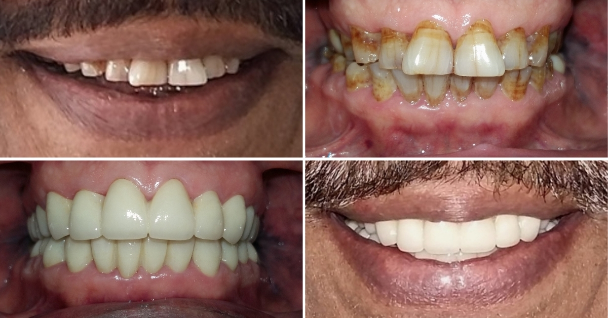 Full Mouth Restoration Abroad