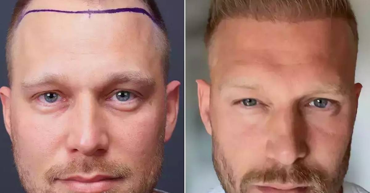 Hair Transplant Turkey Before After