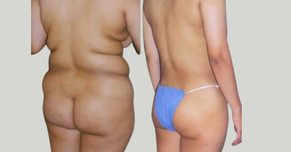 Liposuction in Tijuana, Mexico