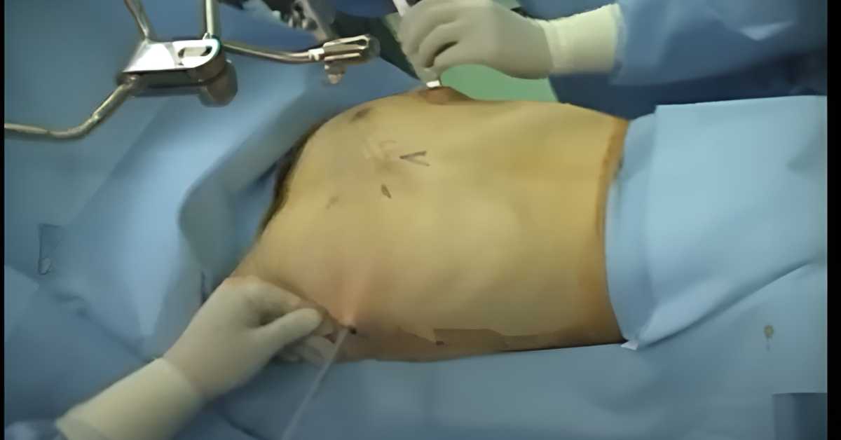 Pectus Excavatum Surgery India