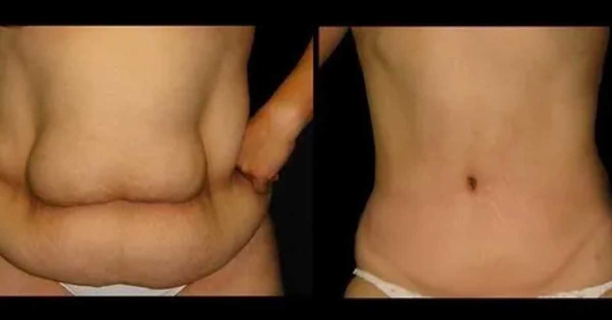 Tummy Tuck in Tijuana – Mexico