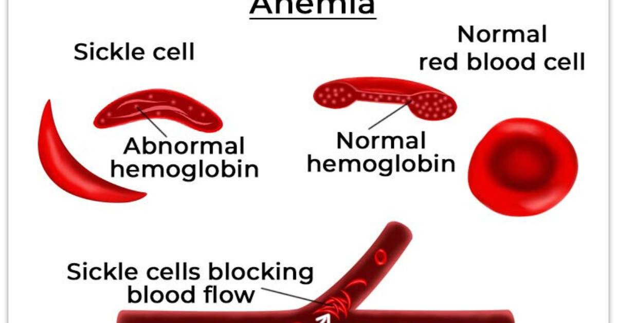 Advanced Stem Cell Therapy for Sickle Cell Anemia in Mexico