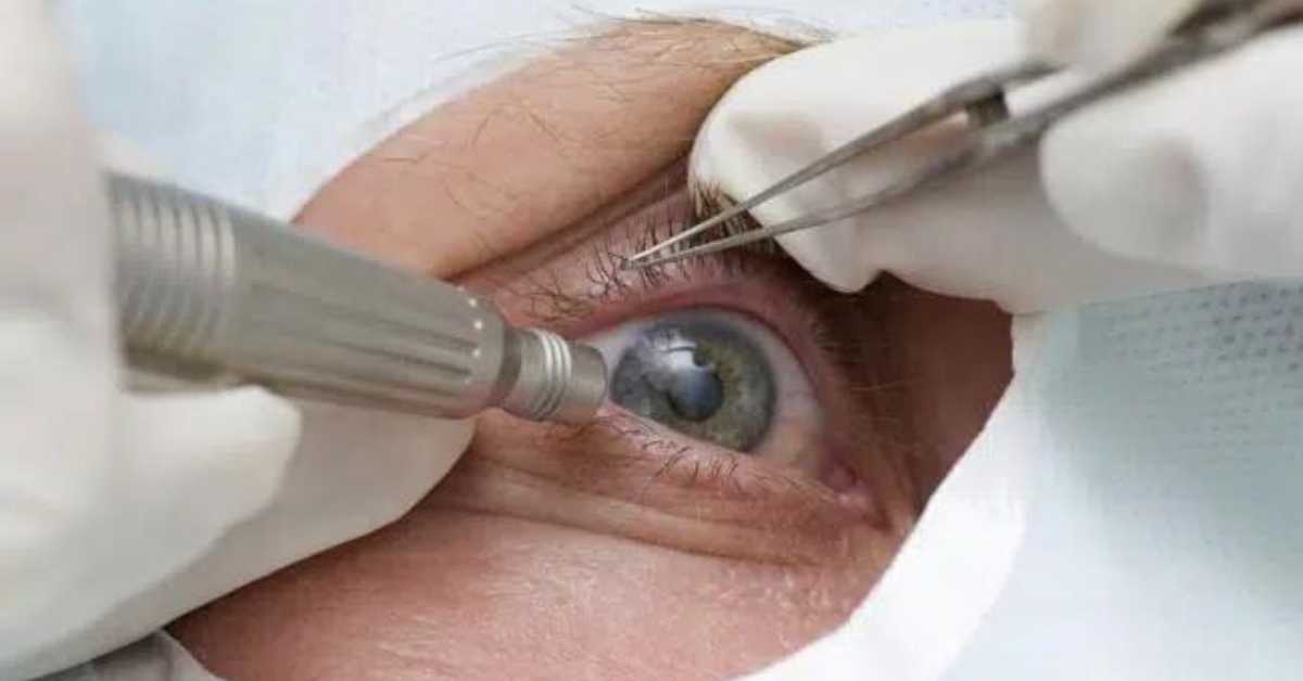 Corneal Transplant Abroad