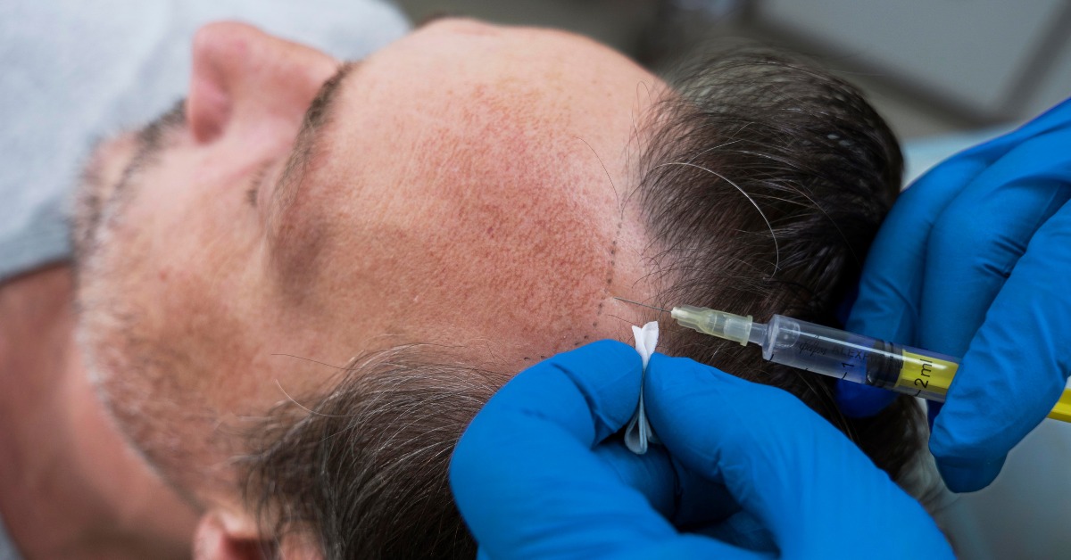 Stem Cell Therapy for Hair Transplant in Mexico