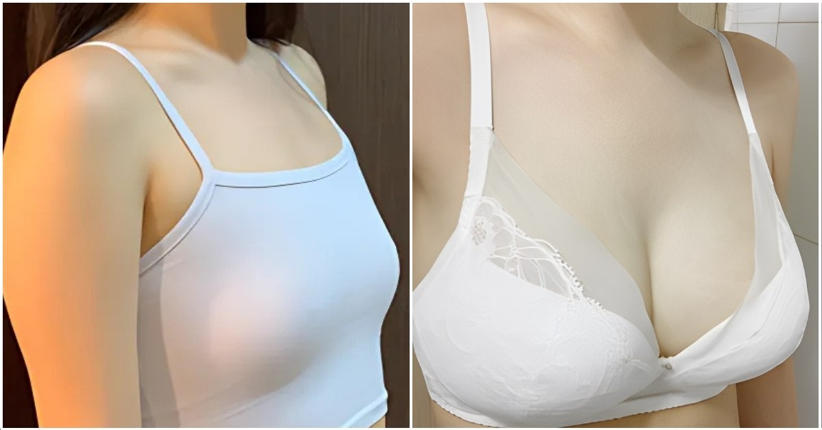 Breast Augmentation in Seoul, Korea