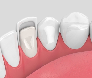 Zirconia veneers package